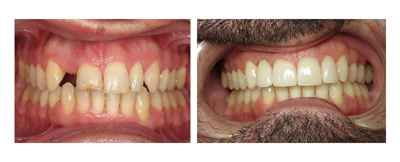 Dental Implants before & after