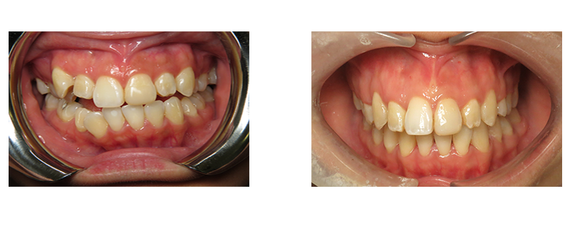Ortho before & after