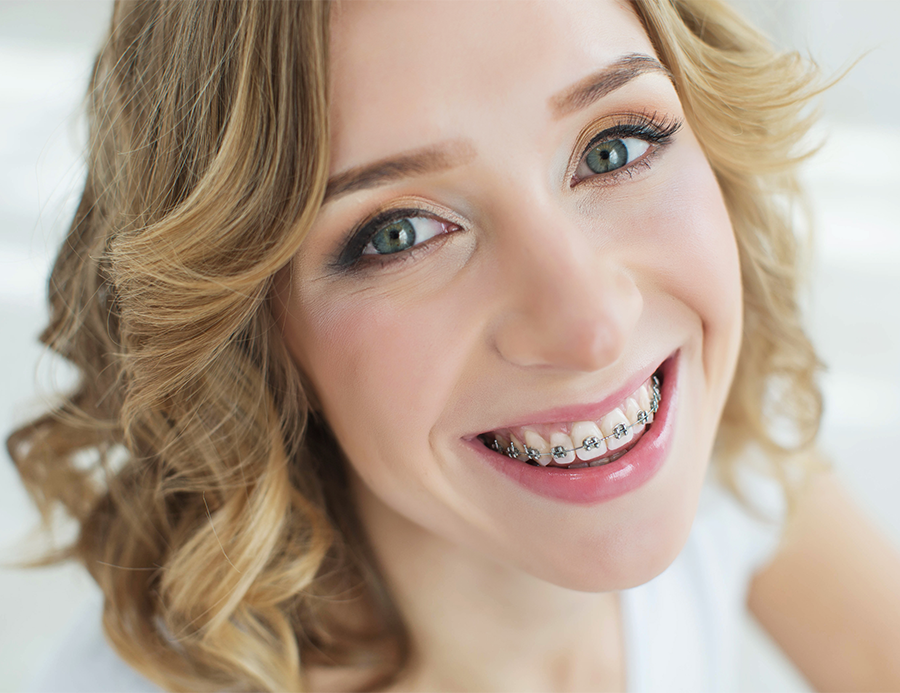 Women with Traditional Braces.