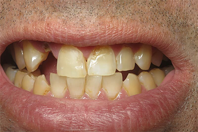 Before and after dental implants and veneers smile transformation at Pacific Sky Dental.
