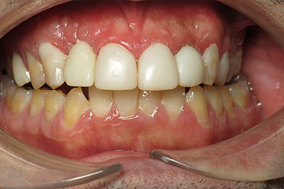 Dental implants and veneers smile transformation at Pacific Sky Dental
