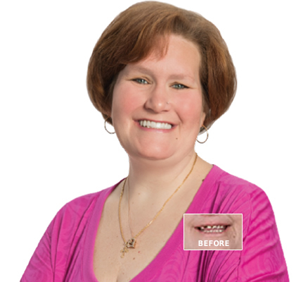 Leigh, TeethXpress® patient before dental implant treatment.