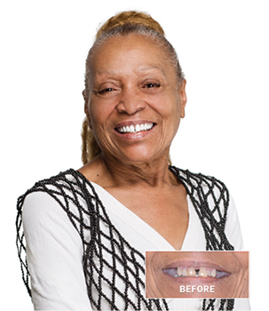 TeethXpress® patient Millie showcasing a confident smile and before image.